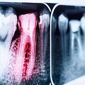 X-ray of tooth highlighted red